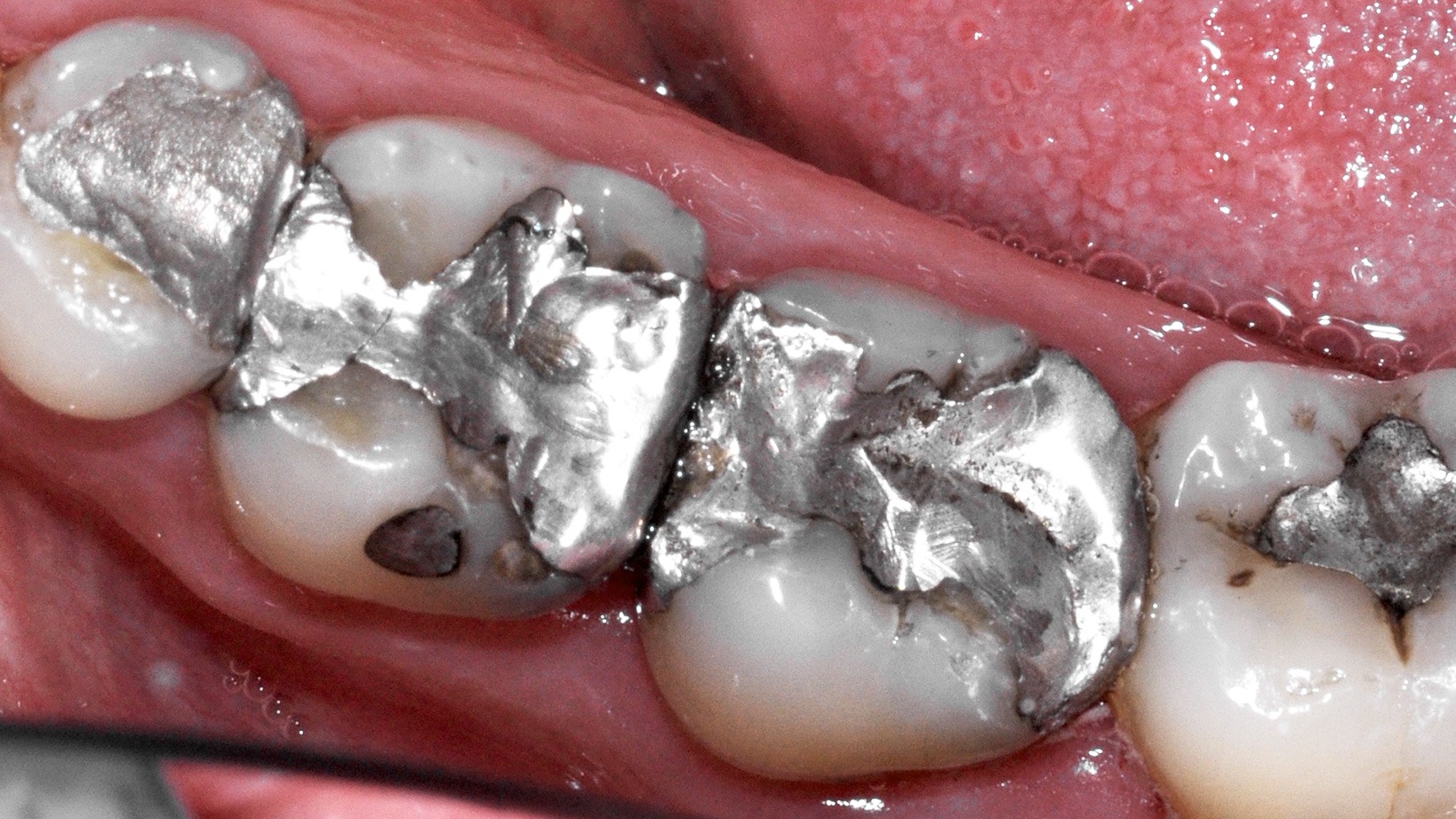 Wurzelbehandelter zahn wird grau.