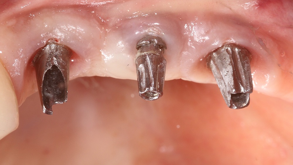 How titanium implants act as antennas for fields DNA