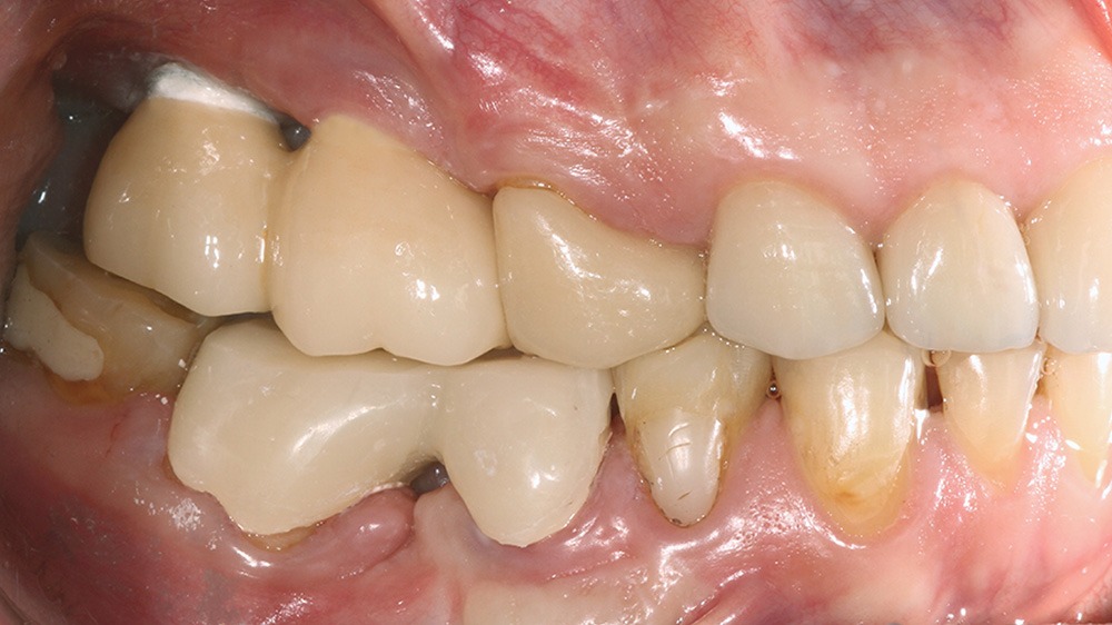 How titanium implants act as antennas for fields DNA