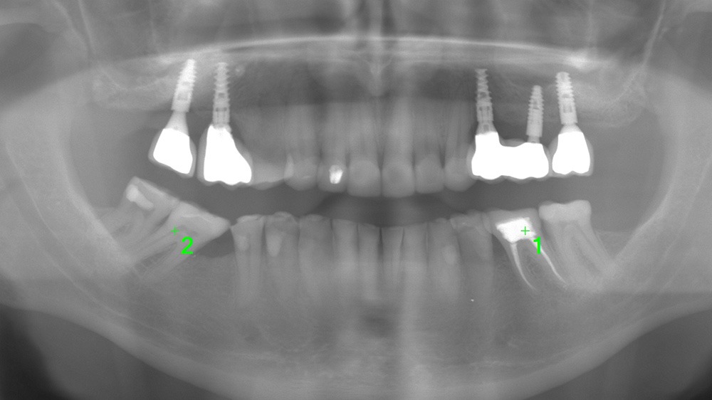 How titanium implants act as antennas for fields DNA